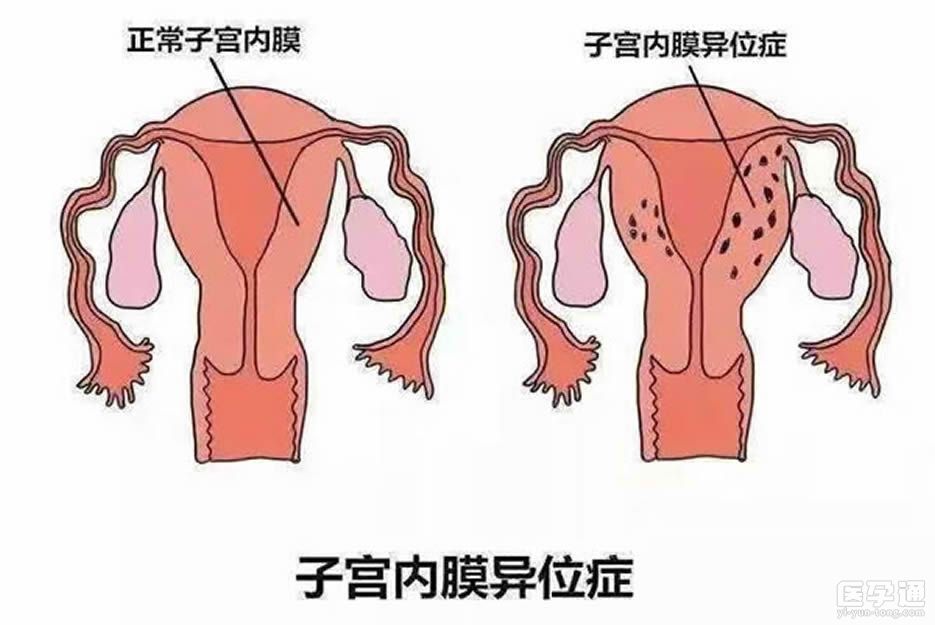 妊娠期子宫右旋图片
