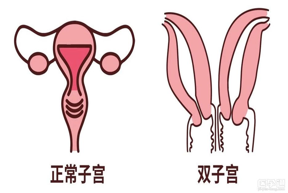 专题解答 双角子宫还能做试管婴儿吗